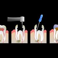 Endodontia