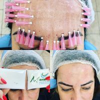 Fios de sustentação PDO facial e labial