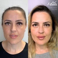 Preenchimento Facial e Labial