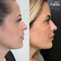 Preenchimento Facial e Labial