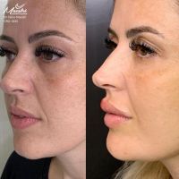 Preenchimento Facial e Labial