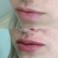 Preenchimento Facial e Labial