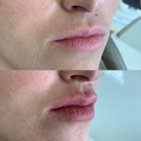 Preenchimento Facial e Labial