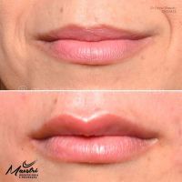 Preenchimento Facial e Labial