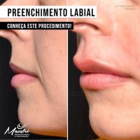 Preenchimento Facial e Labial